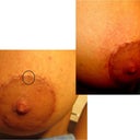 Almost 6 months after, revision of Left Breast