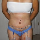 1 week post op - front view