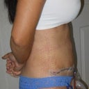 1 week post op - side view