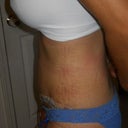 1 week post op - side view left