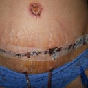 1 week post op - tummy tuck close up