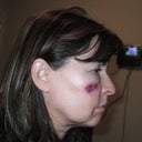 This is the morning after the procedure.  You can compare and see how severe the swelling and bruising was.