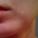 Day 91 after ePrime procedure (using elure Advanced Skin Lightening and two Vitalize peels)