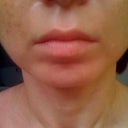 Day 91 after ePrime procedure (still has swelling, especially left side of face, neck and shoulder)