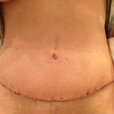 8 Days Post Op. First look at scar.