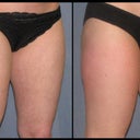 Right after second treatment on right leg.
