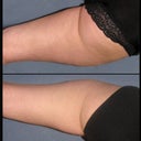 Right after second treatment on right leg.