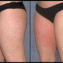 Right after second treatment on right leg.