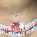 Post Op Day 1