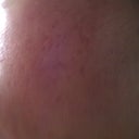 24 HOUR POST TREATMENT - LEFT