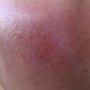 24 HOUR POST TREATMENT - RIGHT