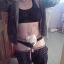 Post Op 2 weeks- Still Swollen but so much better!