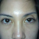 hollow eyelids due to failed asian blepharoplasty