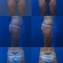 The ones on the left are before, right 1 month after. My scars have since faded! Love it!