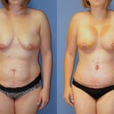 before and one week PO