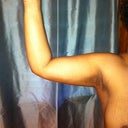 Post op arms - 3 weeks
