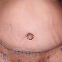 My new tummy & belly button 8/14/11