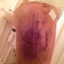 So colourful......................leg bruised from lipo 4 days after surgery