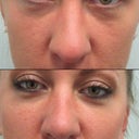 Before after (2.5 months)
