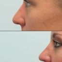 Before after (2.5 months)