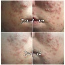 day 17 was my worse..im sure that was my initial purge.  that was the worse my skin has been in my entire life!