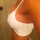 L Side W/ sport bra @day 10