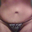 1st Tummy Tuck performed...my right side has over hanging skin and my scar is alot higher up
