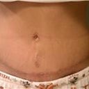 Tummy Tuck revision 2 weeks post op...note below my bellon button is another incision which was my old belly button, which shows you how much skin was still able to be pulled down