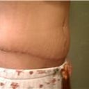 Tummy Tuck revision 2 weeks post op....still pretty swollen on lower abdomin