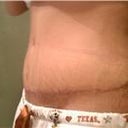 Tummy Tuck revision 2 weeks post op.....still swollen on lower abdomin and pubic region