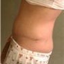 Tummy Tuck revision 2 weeks post op