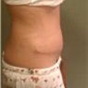 Tummy Tuck revision 2 weeks post op
