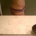 Tummy Tuck 3 weeks post-op ....i never wear granny panties but they were alittlemore comfortable at this point