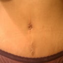 Tummy Tuck 3 weeks post-op.....you can see my swelling in my hips are going down and yu can also see where i had to have my old belly button fixed, but the scar will not be very visable after it heal