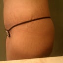 Tummy Tuck 3 weeks post-op.....left hip still swollen but not as much