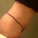 Tummy Tuck 3 weeks post-op......right hip