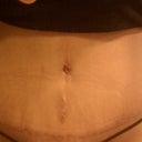 Tummy Tuck 3 weeks post-op.......you can see my swelling in my hips are decreasing and one side is going down faster then the other but it is getting more smooth and flat