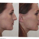 Computer simulation of what my nose will look like after surgery..