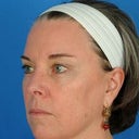 Female Patient Treated For Lax Skin And Sun Damage