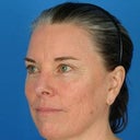 Female Patient Treated For Lax Skin And Sun Damage