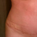 4 week post op scar