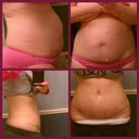 before with hernia (top)
4 weeks post op (bottom) still swollen