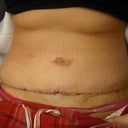 Day 6. Why does my belly button look like a little vagina?  I hope its going to be ok :(