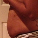 1 Week Post Op-  Side View