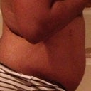 1 Week Post Op- Side View