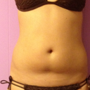 Front 2 weeks post-procedure
