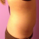 Side 2 weeks post-procedure
