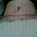Post op day 3, starting to swell a bit