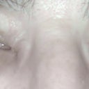 2/2/2013 3 months after the last Restylane injection.