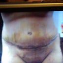 This is 4 days post op here